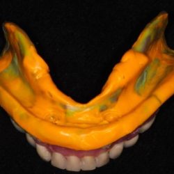 Dentures impressions centric relation preference individually